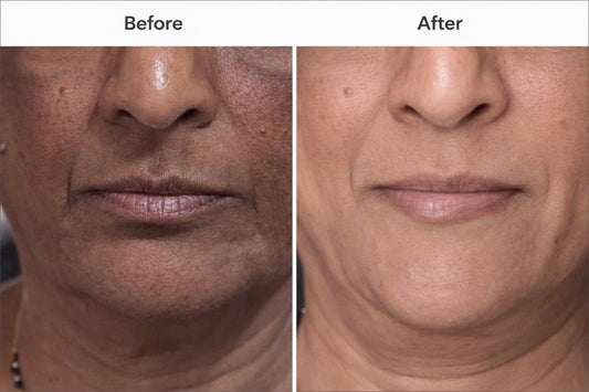 Why Indian Skin Pigments More — Multi-Pathway Pigmentation Treatment That Actually Works | PERSONTAGE