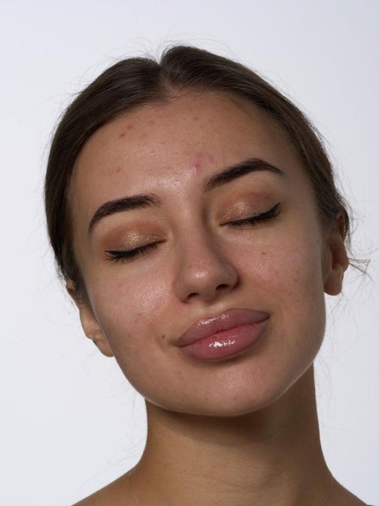 Woman with acne on a white background for ACNE CONTROL ROUTINE – Clarifying Skin Routine Kit.
